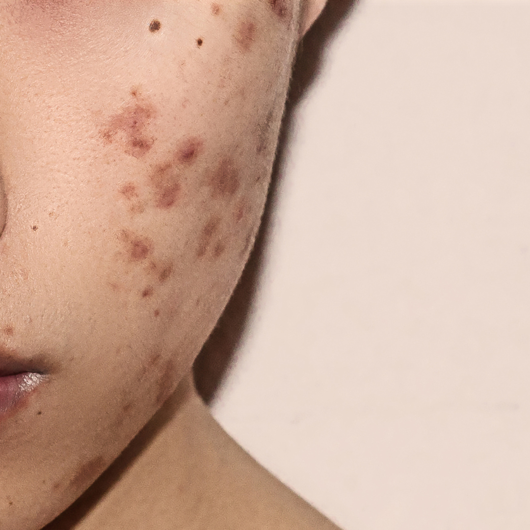 blemishes
