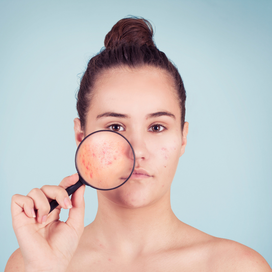 Acne treatment